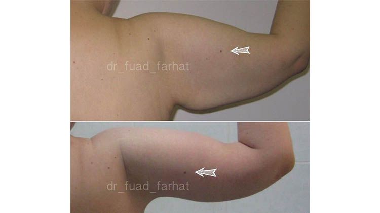 Результаты пластики по удалению провисающей кожи на руках, пластический хирург Фархат Фуад Ахмедович
