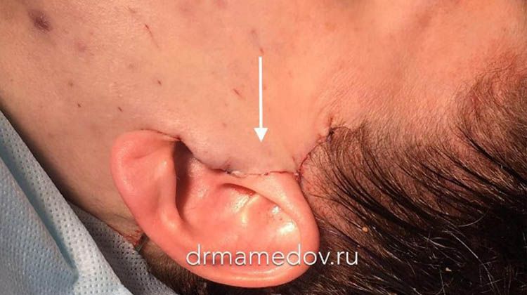 Место доступа при подтяжке нижней части лица на фото, пластический хирург Мамедов Русиф Бежанович