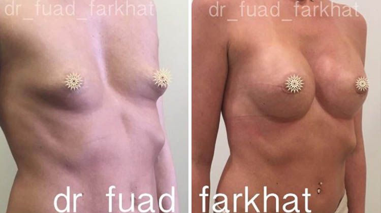 Коррекция груди при деформации грудного отдела, пластический хирург Фархат Фуад Ахмедович