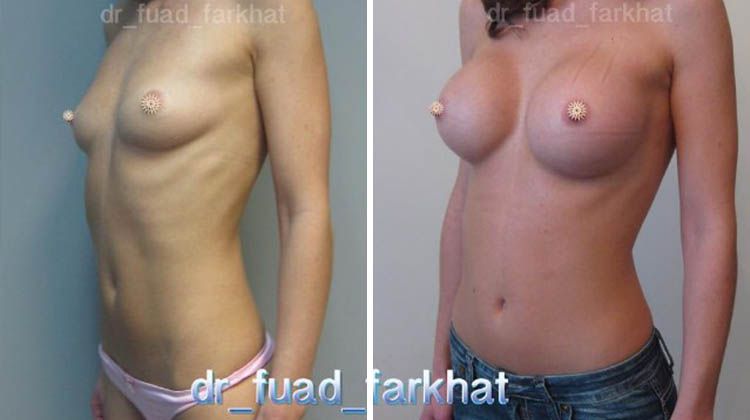 Увеличение груди с эффектом пуш-апа, пластический хирург Фархат Фуад Ахмедович