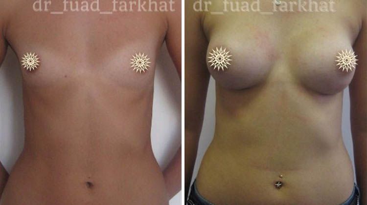 Результаты увеличения груди имплантатами объемом 295 мл анатомической формы, пластический хирург Фархат Фуад Ахмедович