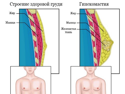 Вид мужской грудной железы в норме и при гинекомастии