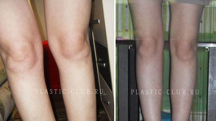 Отчет пациентки после пластики голени, пластический хирург Фото до и после пластики голени
