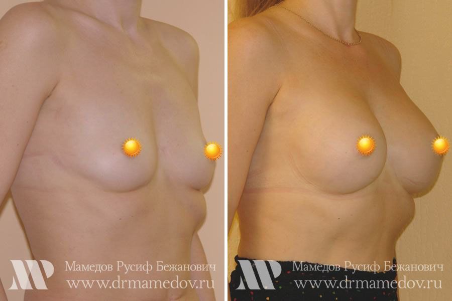 Результаты увеличения груди с помощью круглых имплантатов объемом 195 мл, пластический хирург Мамедов Русиф Бежанович