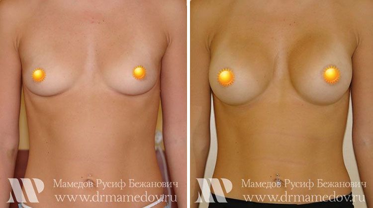 Результаты увеличения груди круглыми имплантатами объемом 270 мл, пластический хирург Мамедов Русиф Бежанович