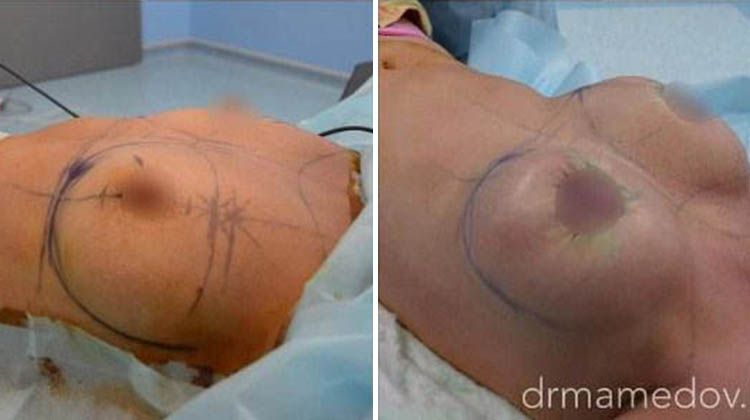 Увеличивающая маммопластика имплантатами объема 320 мл, пластический хирург Мамедов Русиф Бежанович