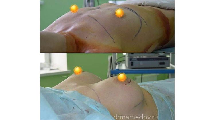 Результаты успешной установки имплантатов анатомической формы объема 270 мл, пластический хирург Мамедов Русиф Бежанович
