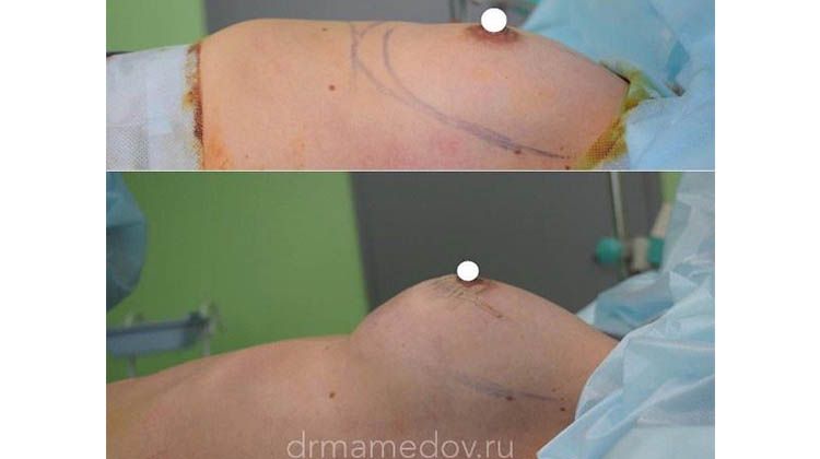 Итоги работы по увеличению груди пациентки анатомическими имплантатами 280 сс, пластический хирург Мамедов Русиф Бежанович