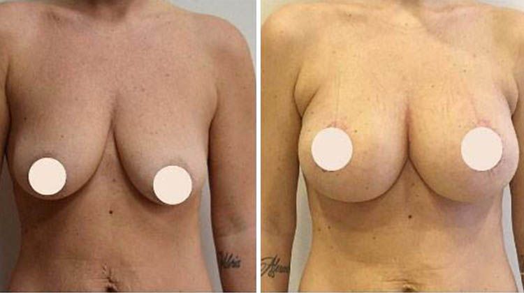 Результат периареолярной мастопексии (подтяжки груди), пластический хирург Мамедов Русиф Бежанович