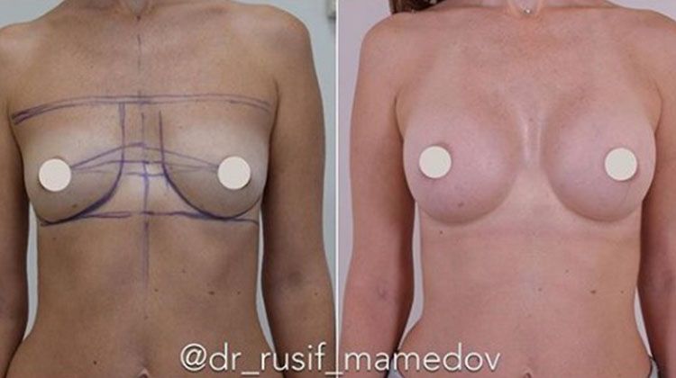 Результаты эндопротезирования груди имплантатами объемом 275 сс, пластический хирург Мамедов Русиф Бежанович