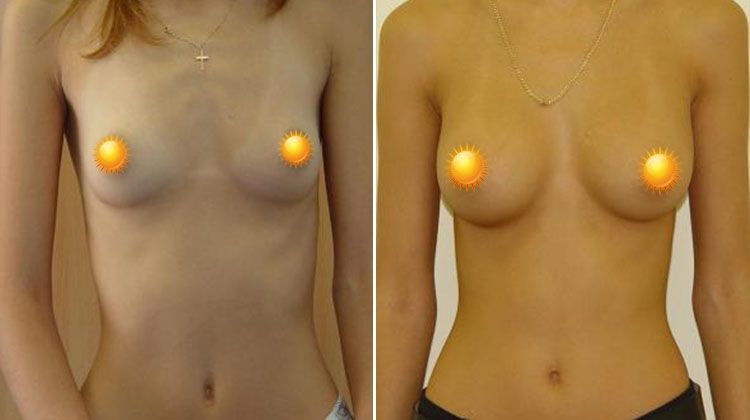 Эндоскопическое увеличение груди из подмышечного доступа анатомическими имплантатами, пластический хирург Мамедов Эльчин Велиевич