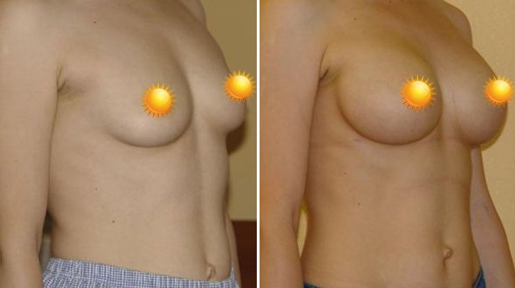 Увеличение груди из периареолярного доступа имплантатами круглой формы, пластический хирург Мамедов Эльчин Велиевич