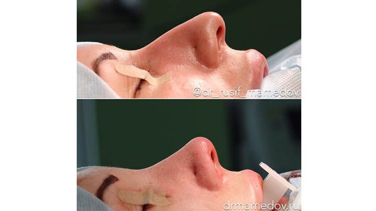 Атравматическая динамичная риноскульптура носа, пластический хирург Мамедов Русиф Бежанович