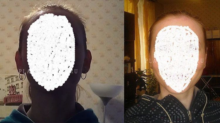 Фотоотчет пациентки после отопластики обоих ушей, пластический хирург Фото до и после отопластики