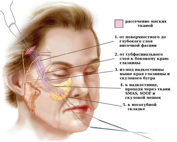 Эндоскопическая подтяжка лица и шеи