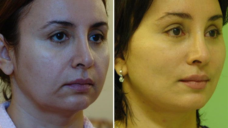 Эндопластика средней зоны лица с подъемом углов рта, пациентка 47 лет, пластический хирург Мамедов Эльчин Велиевич