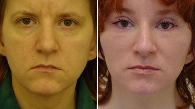 Пластическое омоложение лица и смена имиджа, пациентка 42 года, пластический хирург Мамедов Эльчин Велиевич