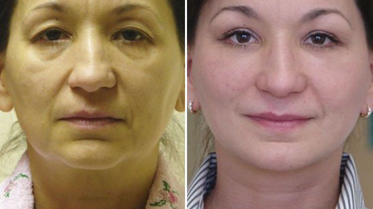 Комплексная пластика по омоложению лица и шеи, пациентка 49 лет, пластический хирург Мамедов Эльчин Велиевич