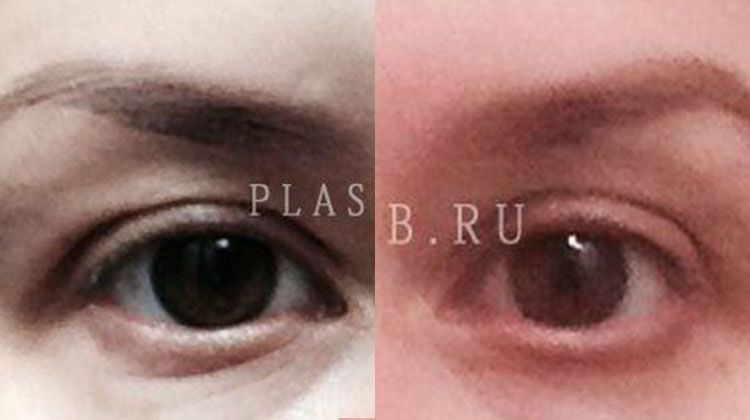 История пациентки о результатах блефаропластики верхних век, пластический хирург Фото до и после верхней блефаропластики