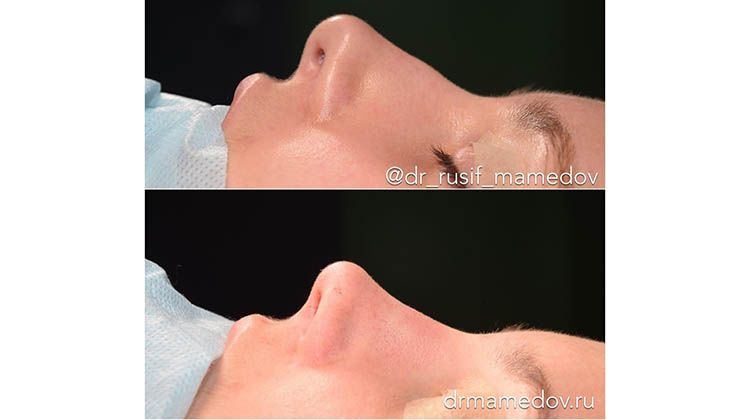Результаты операции динамичная риноскульптура на носу , пластический хирург Мамедов Русиф Бежанович