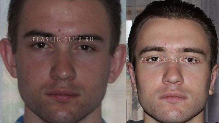 Отзыв пациента о перенесенной отопластике обоих ушей, пластический хирург Фото до и после двусторонней отопластики