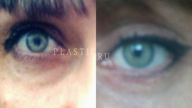 Фотоотчет пациентки, перенесшей круговую блефаропластику, пластический хирург Фото до и после блефаропластики