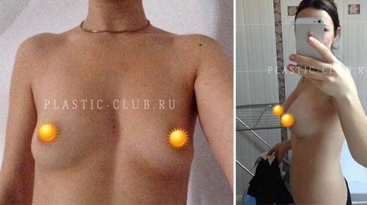 История пациентки, прошедшей операцию по увеличению груди имплантатами с объемом 450 мл, пластический хирург Фархат Фуад Ахмедович