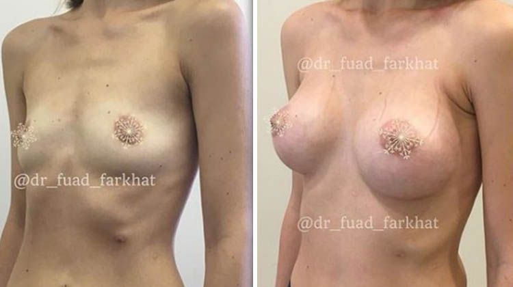 Результаты увеличения груди с установкой имплантата под мышцу через ареольный доступ, пластический хирург Фархат Фуад Ахмедович