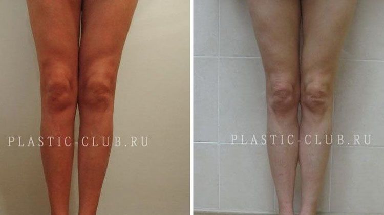 История пациентки, прошедшей пластику голени, пластический хирург Фото до и после пластики голени