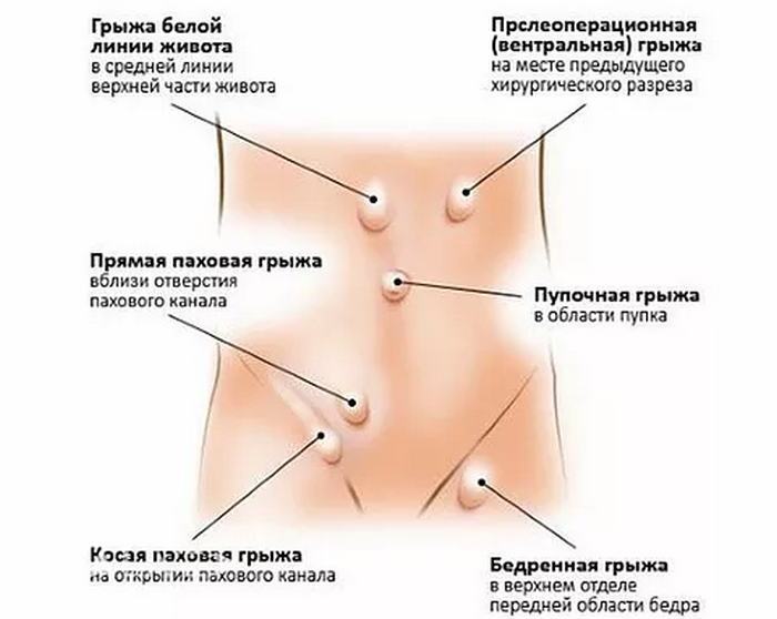 Виды грыж