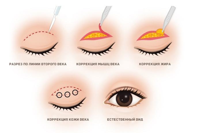 Классический инцизионный метод пластики азиатского века