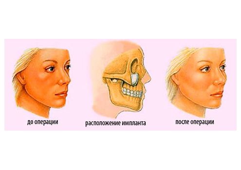 Малярпластика с помощью имплантов
