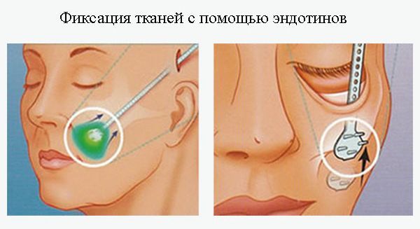 Установка эндонтинов