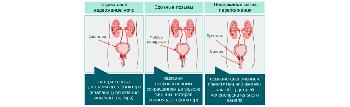 Типы лечения недержания мочи