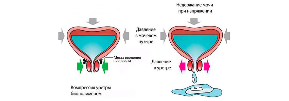 Результат лечения недержания мочи