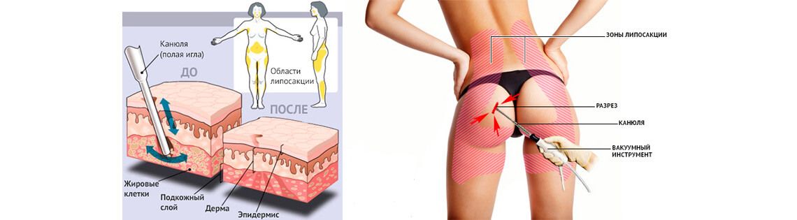 Как делают липосакцию