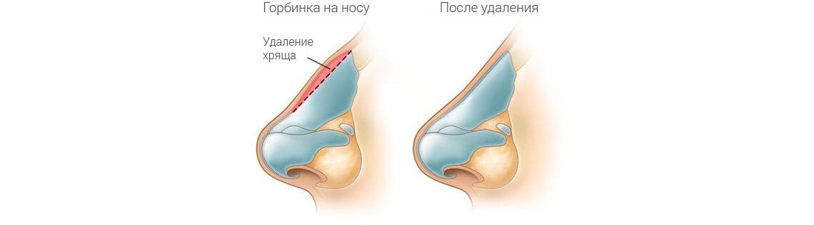 Удаление горбинки носа