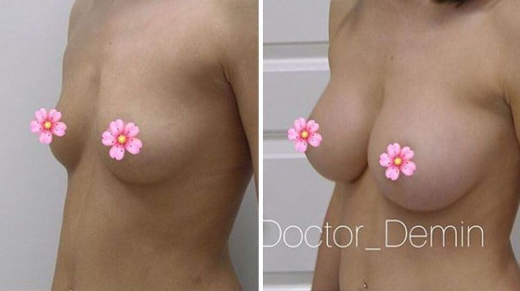Результаты увеличения груди без эффекта «пуш-ап», пластический хирург Демин Сергей Анатольевич