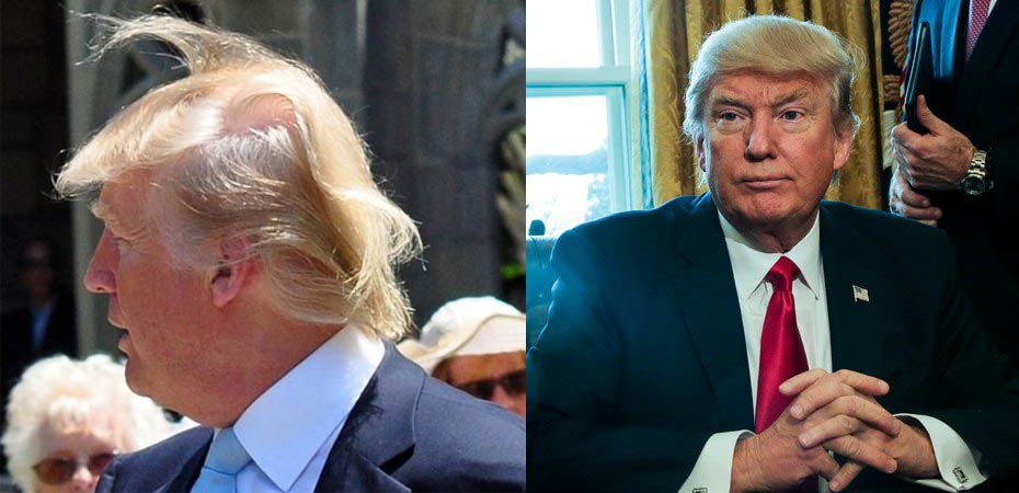 Дональд Трамп до и после пересадки волос