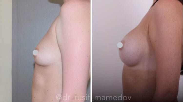 Результаты пластики груди имплантатами 320 мл, пластический хирург Мамедов Русиф Бежанович