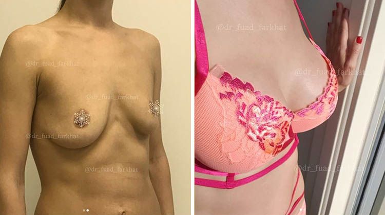 Результаты увеличения груди с 3D подтяжкой, пластический хирург Фархат Фуад Ахмедович