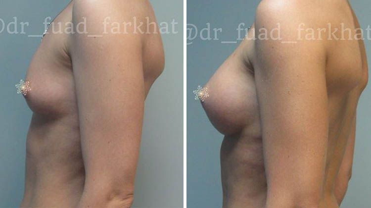 Результаты установки круглых имплантатов в грудь, пластический хирург Фархат Фуад Ахмедович
