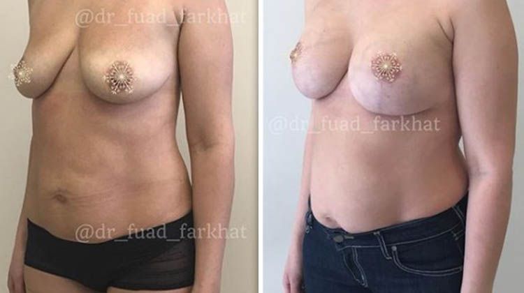 Результаты увеличения груди с удалением избытка кожи, пластический хирург Фархат Фуад Ахмедович