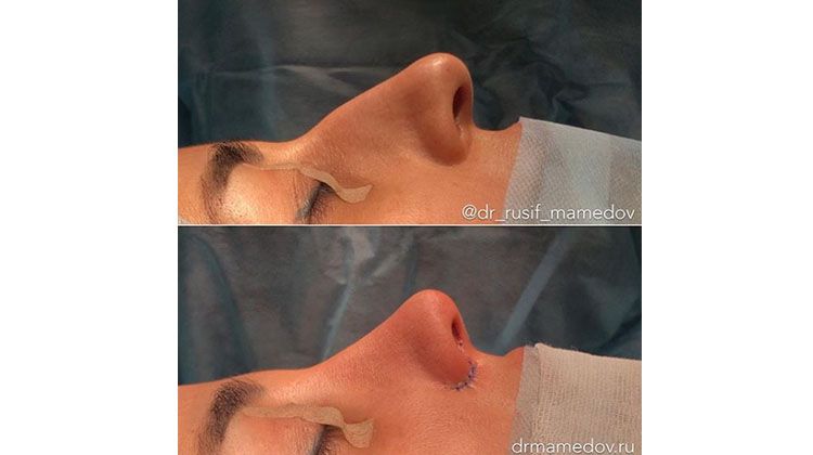 Результаты операции атравматичная закрытая пластика носа, пластический хирург Мамедов Русиф Бежанович