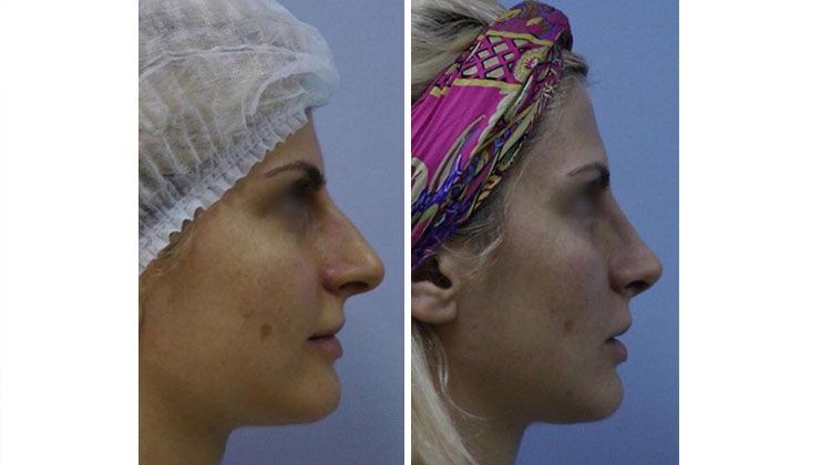 Результаты моделирования кончика, хрящей и перегородки носа, пластический хирург Меладзе Зураб Амиранович