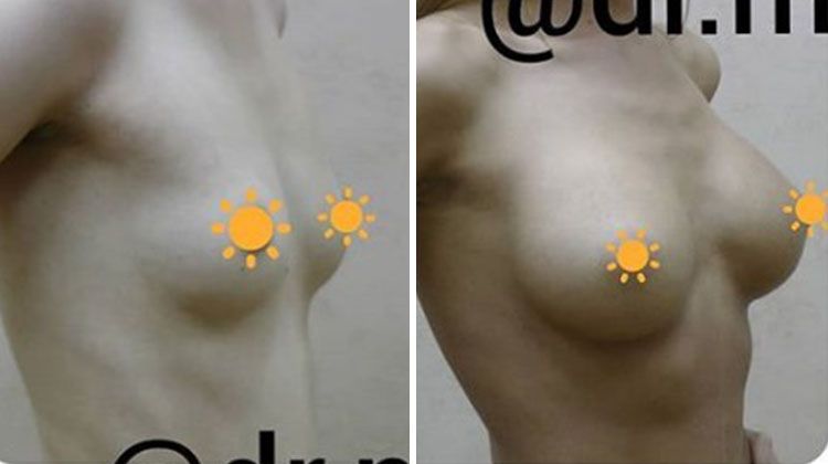 Результаты композитного увеличения груди для получения естественного результата, пластический хирург Меладзе Зураб Амиранович