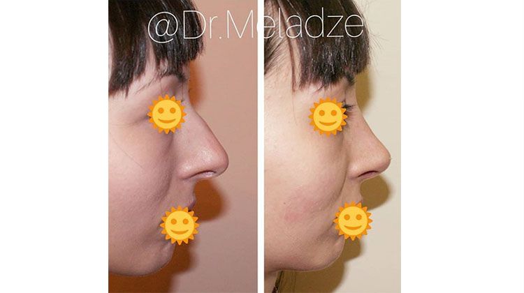 Результаты сентопластики носа, пластический хирург Меладзе Зураб Амиранович
