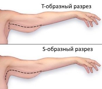 Типы швов при брахиопластике