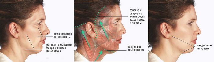 Ход операции при подтяжке шеи