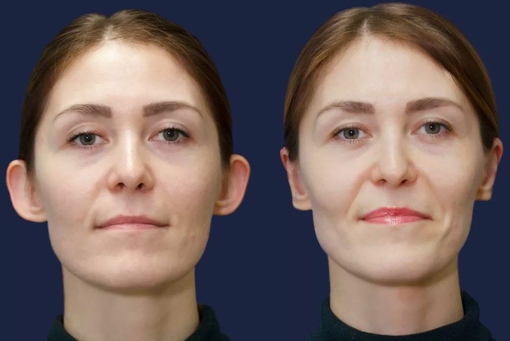 Фото операции на уши до и после операции